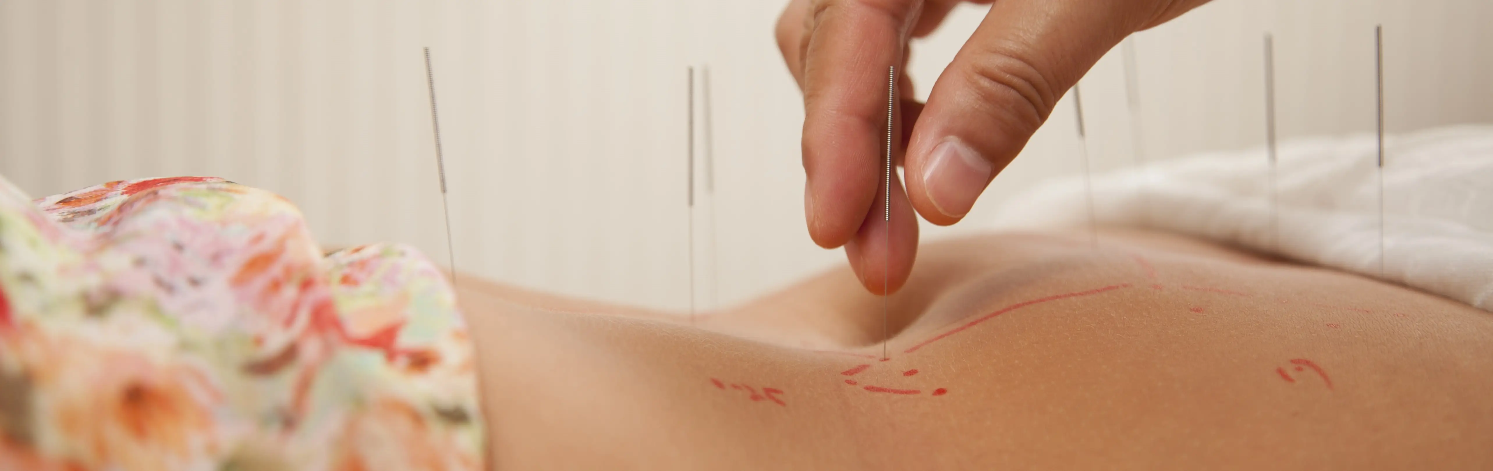Acupuncture