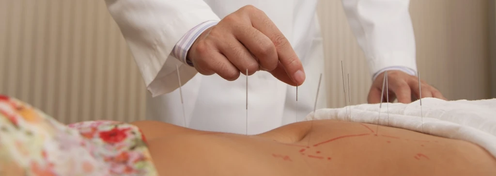 acupuncture
